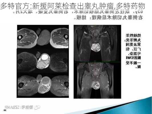 多特官方:新援阿莱检查出睾丸肿瘤,多特药物